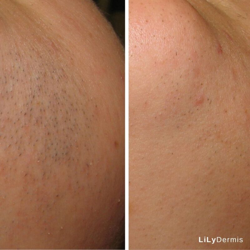 Diolaze Laser Hair Removal LiLyDermis Calgary