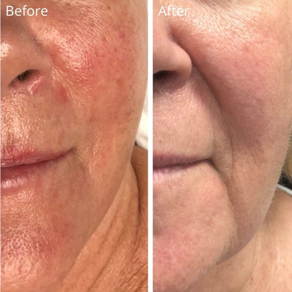 Laser Rosacea LiLyDermis Calgary
