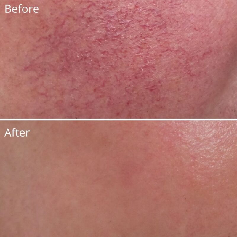 Laser Rosacea LiLyDermis Calgary