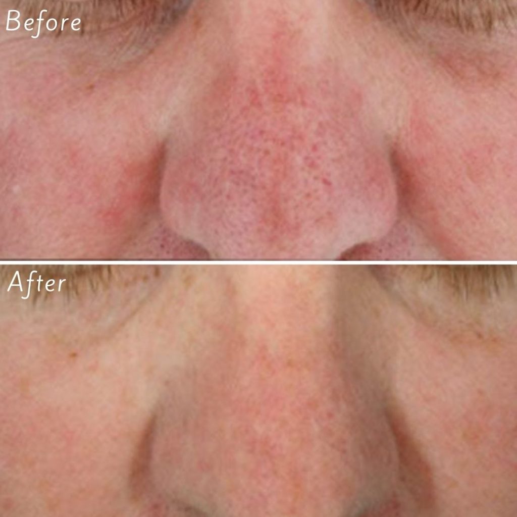 HydraFacial Calgary LiLyDermis