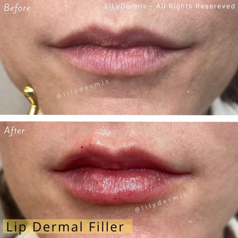 Dermal Fillers LiLyDermis Calgary Alberta Canada