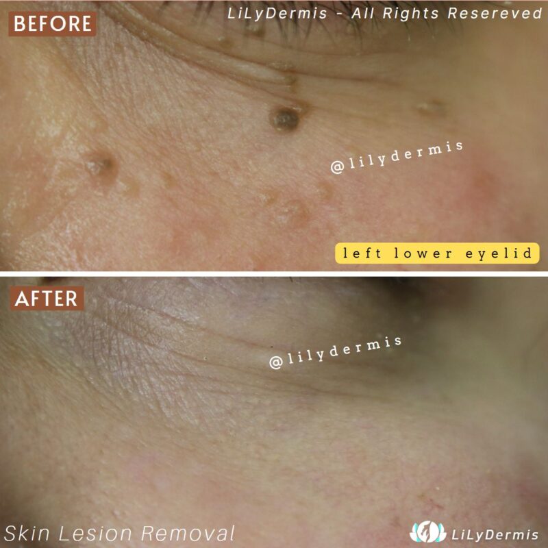 Syringoma Removal LiLyDermis Calgary