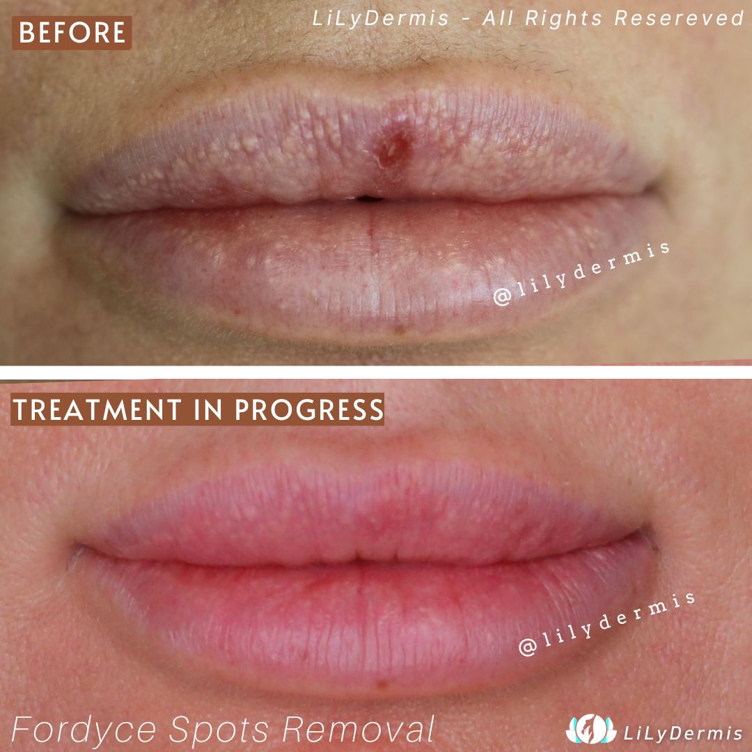 Natural Remedies Fordyce Spots