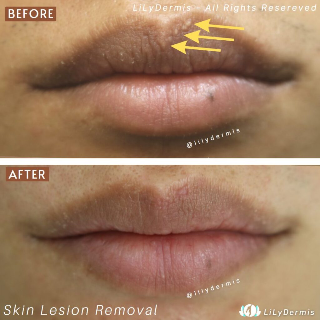 fordyce-spot-removal-lilydermis-calgary