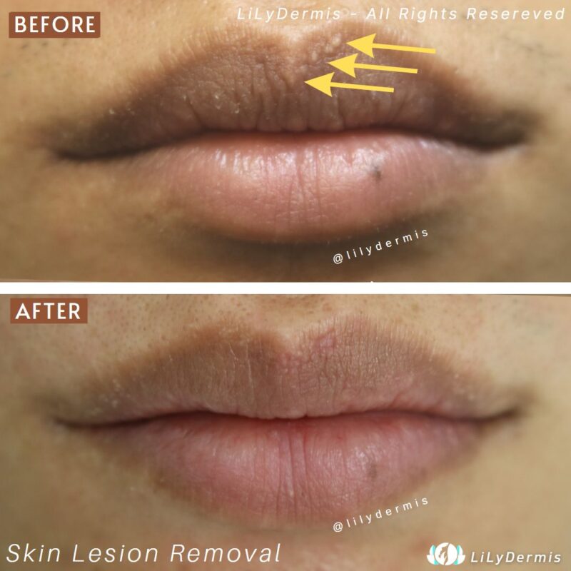 fordyce-spot-removal-lilydermis-calgary