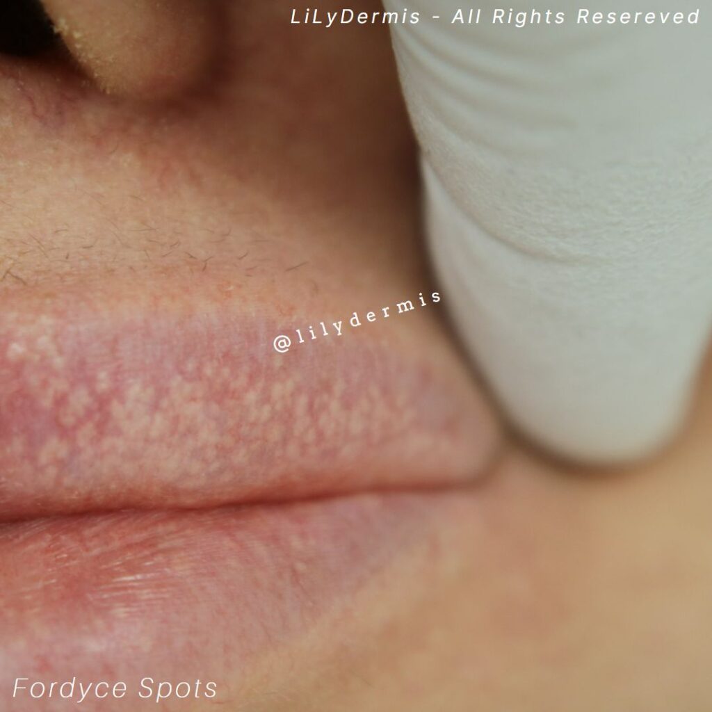 Fordyce Spot Removal LiLyDermis Calgary