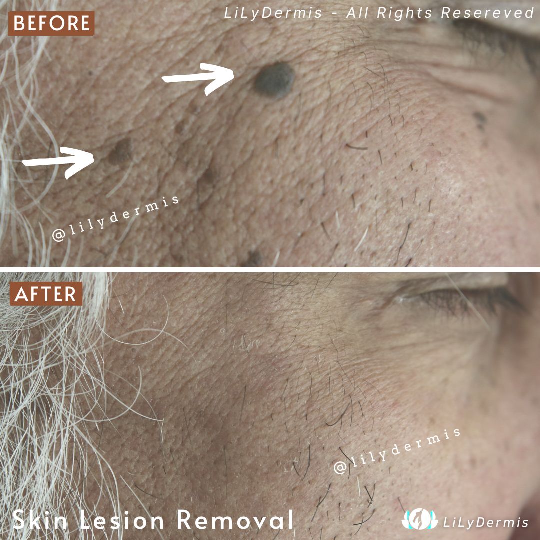 Seborrheic Keratosis Removal LiLyDermis Calgary Seborrheic Keratosis Removal LiLyDermis Calgary