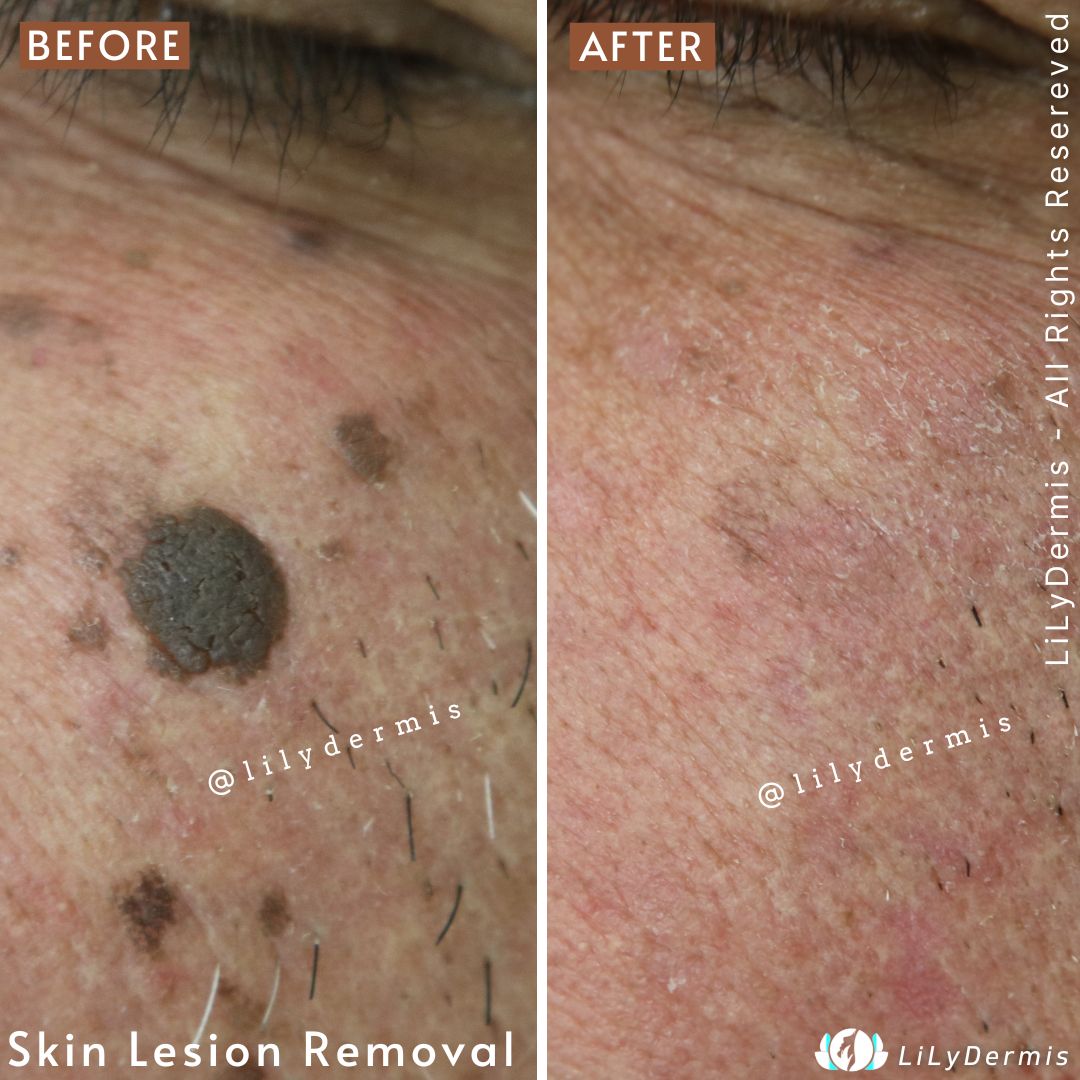 Seborrheic Keratosis Removal LiLyDermis Calgary Seborrheic Keratosis Removal LiLyDermis Calgary