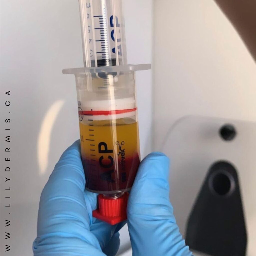 PRP in Calgary | Platelet-Rich Plasma Facial at LiLyDermis